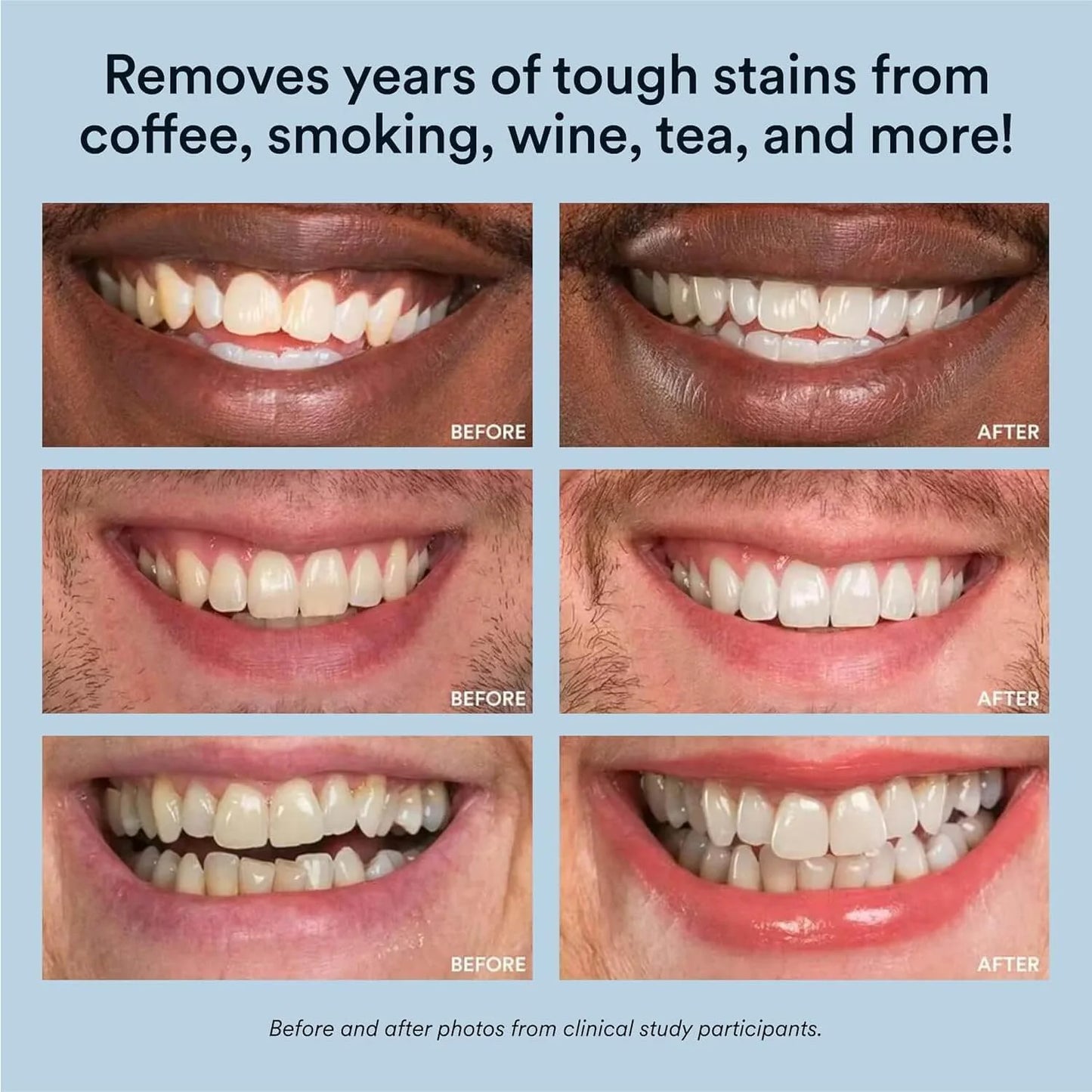 Teeth Whitening Kit