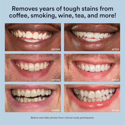 Teeth Whitening Kit